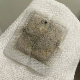Plaster po 4 tygodniach